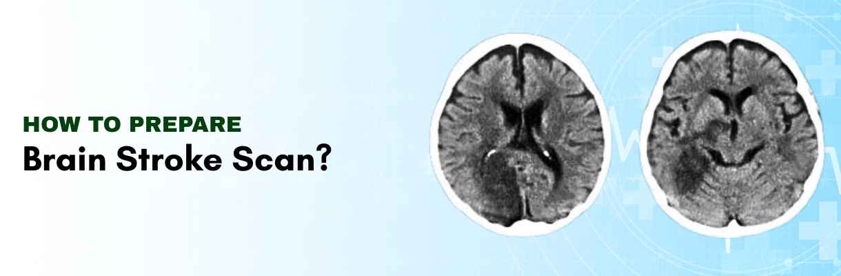 How to Prepare for Brain Stroke Scan?